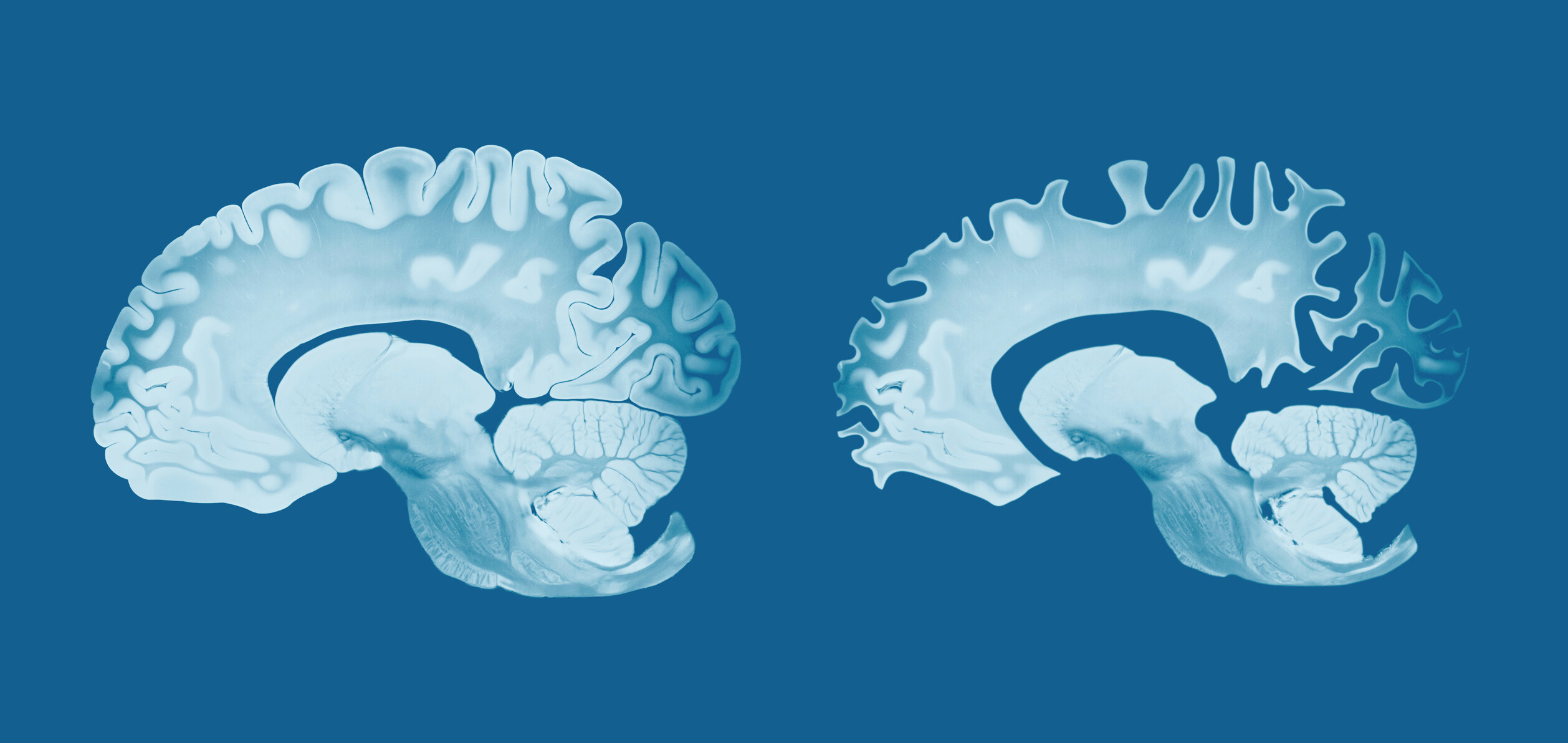 MPFI_ Brain Protein Loss Eases Alzheimer&rsquo;s